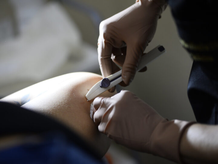 Novo implante anticoncepcional já pode ser solicitado nas UBSs do DF