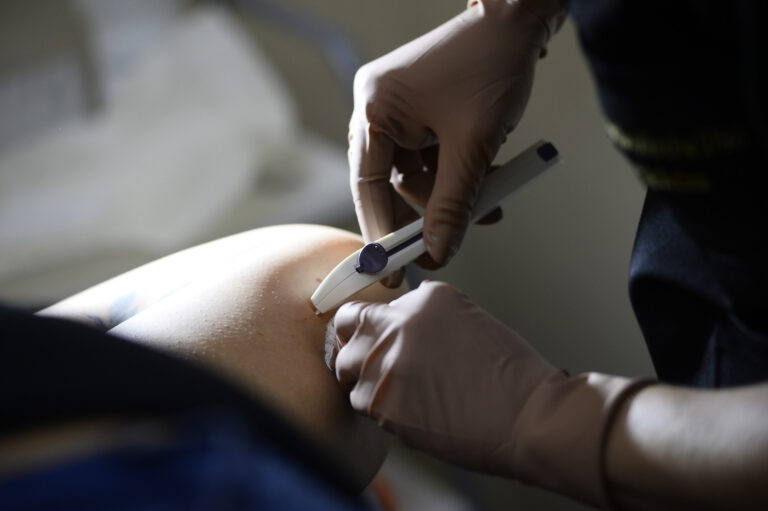 Inserção é simples e rápida, feita por médicos e enfermeiros devidamente capacitados, apenas com anestesia local; após o procedimento, o dispositivo pode atuar no organismo por até três anos | Foto: Matheus Oliveira/Agência Saúde DF