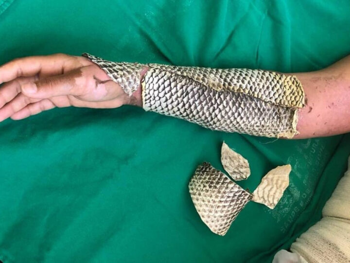 Pele de tilápia para queimaduras terá fábrica inédita no Brasil