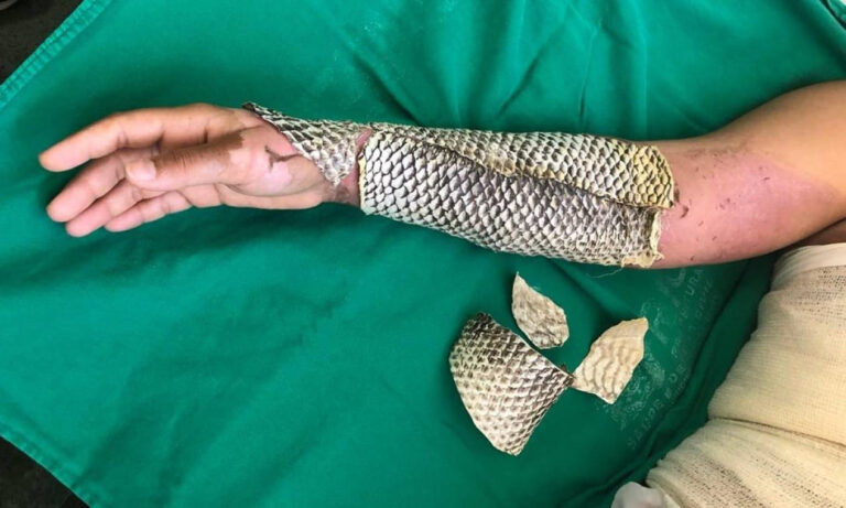 Pele de tilápia para queimaduras terá fábrica inédita no Brasil