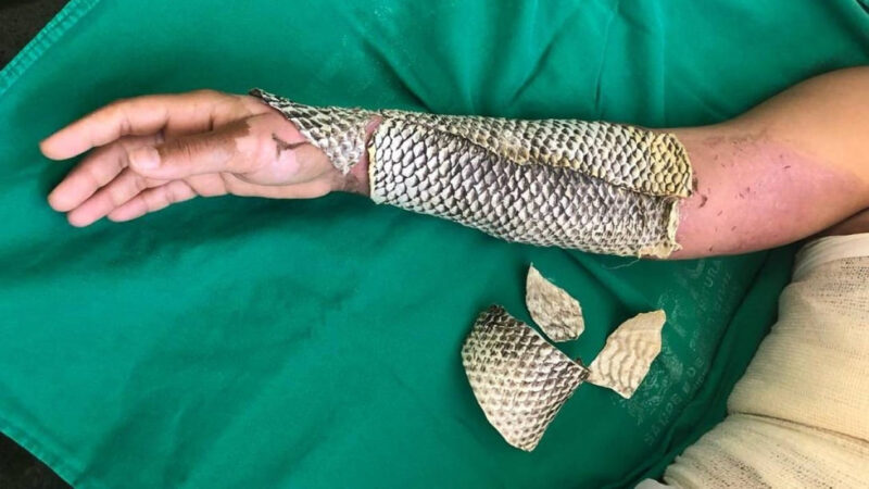 Pele de tilápia para queimaduras terá fábrica inédita no Brasil